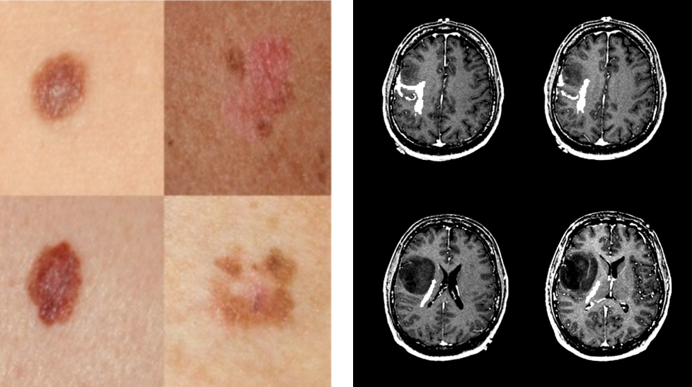 Why Skin Lesions are Peanuts and Brain Tumors Harder Nuts